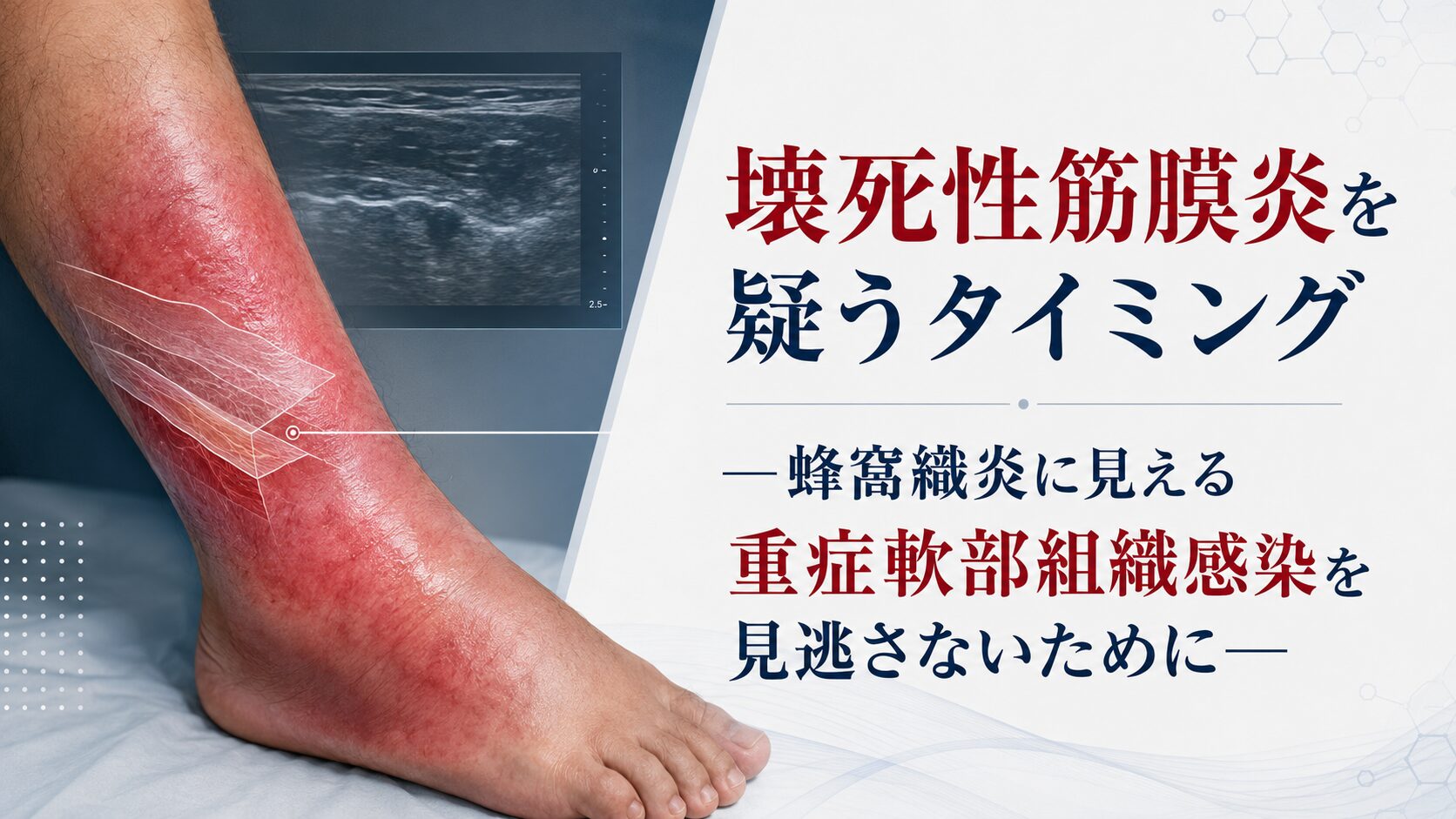 壊死性筋膜炎を疑うタイミング―蜂窩織炎に見える重症軟部組織感染を見逃さないために―
